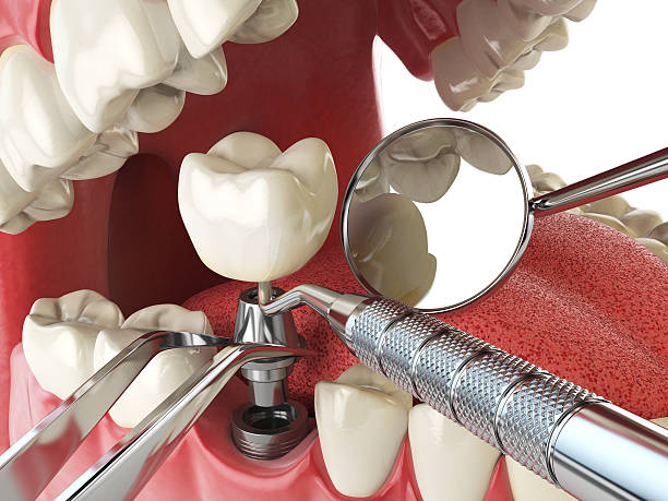 Best Emergency Tooth Extraction in Millville, DE